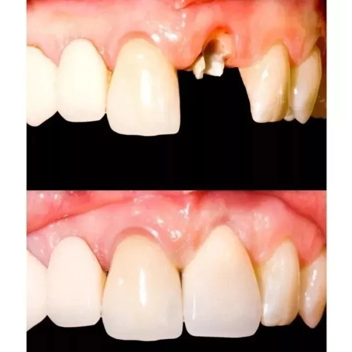 06 COROAS OCAS FACETAS PARA OS DENTES COR A2 + MASSA ( BOLINHAS ) PRONTA ENTREGA